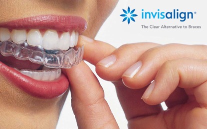 Invisalign beugel Rosmalen